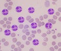 Neutrophil with vacular on red blood cell