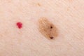 Nevus and cherry angioma on human skin