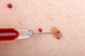 Nevus and cherry angioma on human skin Royalty Free Stock Photo