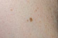 Nevus on human skin close-up Royalty Free Stock Photo