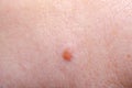 Nevus on human skin close-up