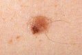 Nevus on human skin