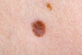 Nevus on human skin