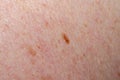 Nevus on human skin closeup Royalty Free Stock Photo