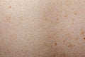 Nevus on human skin closeup Royalty Free Stock Photo