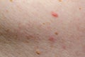 Nevus on human skin closeup Royalty Free Stock Photo