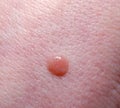 Nevus on human skin close-up