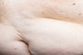 Nevus on human skin, obesity