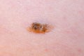 Nevus keratoma on the skin of an adult close-up