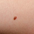 Nevus or mole on the human body close-up. Skin cancer, keratosis or melanoma on the skin