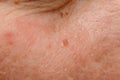 Nevus, papilloma on the face. Benign skin growth caused by papilloma virus. Dermatology concept, papillomas removal.