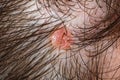 Nevus sebaceus on scalp Royalty Free Stock Photo