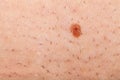 Nevus on a shaved human skin