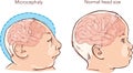 Newborn baby with Microcephaly disease caused