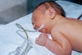 Newborn baby with neonatal jaundice is sleeping after surgery