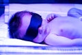 Newborn baby receiving phototherapy for jaundice