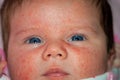 Newborn Baby With Severe Baby Acne Possibly from an Adverse Reaction to Shots Given at Birth