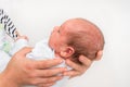 Newborn baby with skin rash. Allergic reaction after birth Royalty Free Stock Photo