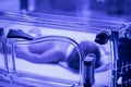 Newborn baby under ultraviolet lamp is getting treated for jaundice elevated bilirubin