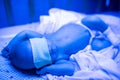 Newborn having a treatment for jaundice under ultraviolet lamp in home bed Royalty Free Stock Photo