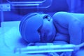 Newborn jaundice Royalty Free Stock Photo