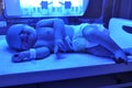 Newborn jaundice