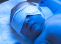 Newborn jaundice treatment Royalty Free Stock Photo