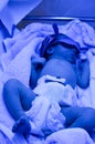 Newborn with jaundice under ultraviolet a light.