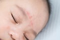 Newborn sleeping. There is a mark on the forehead from accidental scratches