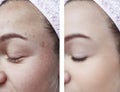 girl beauty skin wrinkles eyes removal before and after cosmetology procedures