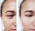 girl beauty wrinkles eyes before and after procedures Royalty Free Stock Photo