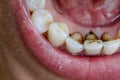 Nicotine and caffeine stains on bottom teeth Royalty Free Stock Photo