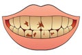 Nicotine Stained Teeth