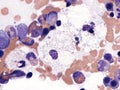 Niemann Pick cells in bone marrow