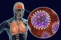 Nipah virus infection