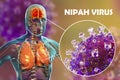 Nipah virus infection