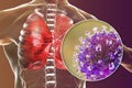 Nipah virus in lungs