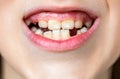 No teeth. Yellow teeth. Bad dental health, no teeth, no fluoride, tooth erosion. Portrait boy with bad teeths. Child bad Royalty Free Stock Photo