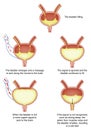 Nocturnal enuresis (bed-wetting)