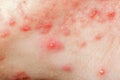 Nodular cystic acne skin Royalty Free Stock Photo