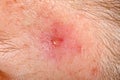 Nodular cystic acne skin