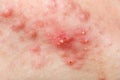 Nodular cystic acne skin Royalty Free Stock Photo