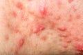 Nodular cystic acne skin