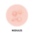 Nodules skin acne type vector icon. Skin disease acne nodules pimples type, face pore comedones