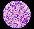 Non Hodgkin lymphoma. Metastatic carcinoma. USG of Liver SOL