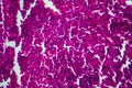 Non-Hodgkin`s lymphoma, light micrograph Royalty Free Stock Photo