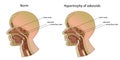 Norm and hypertrophy of adenoids. Location of adenoids. Royalty Free Stock Photo