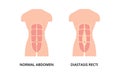 Normal abdomen muscles of man and diastasis recti Royalty Free Stock Photo