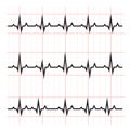 Normal and abnormal ECG medical science