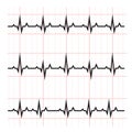 Normal and abnormal ECG medical science